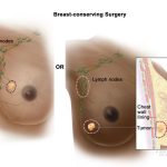 breast cancer