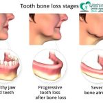 bone loss in teeth